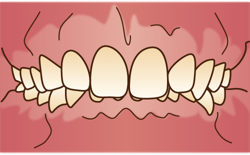 過蓋咬合(かがいこうごう)