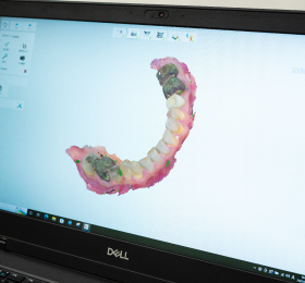 口腔内スキャナー